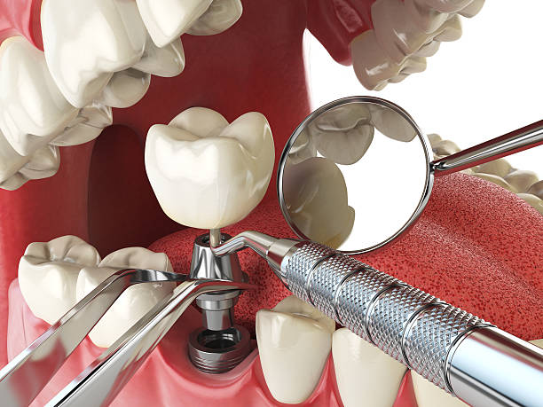 Best Broken or Chipped Tooth Repair in Lawrence, KS